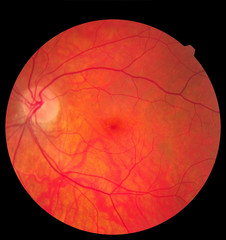 Ophthalmic image detailing the retina and optic nerve inside a healthy human eye. Medicine concept