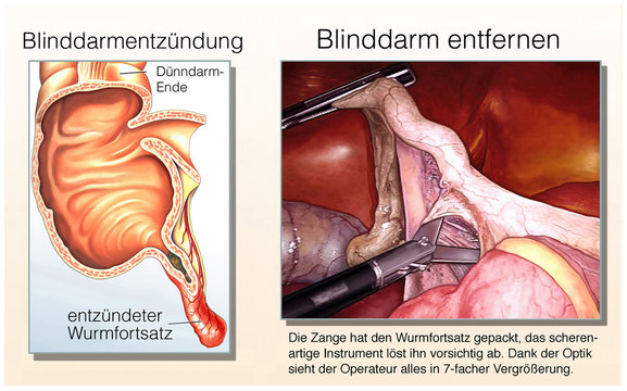 Blinddarmentfernung.Appendektomie.Blinddarmentz&uuml;ndung