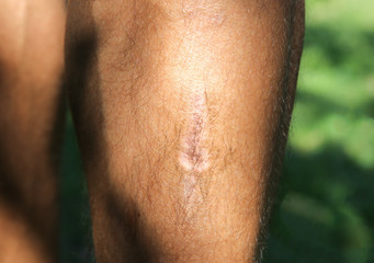 Old scar on man's leg. Accident in the past.