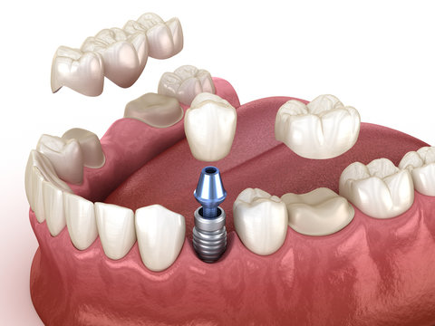 Tooth recovery with implant and crown. Medically accurate 3D illustration dental concept.