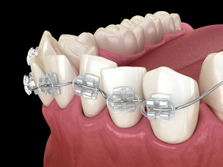 Abnormal teeth position and clear braces tretament. Medically accurate dental 3D illustration