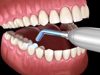 Tooth restoration with filling and polymerization lamp. Medically accurate tooth 3D illustration.