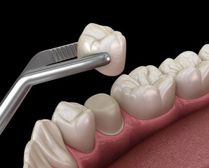 Preparated premolar tooth and ceramic crown placement. Medically accurate 3D illustration