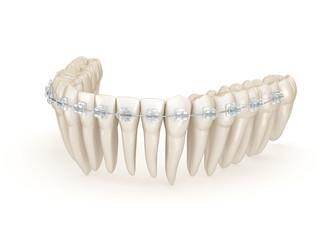 Teeth and Clear braces. 3D illustration concept