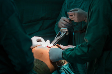 Team surgeon at work in operating room. total hip arthroplasty with cement fixation of components