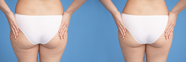 Female buttocks on a blue background before and after losing weight.