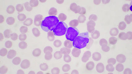 Blast cell in leukemia pateins in blood smear.