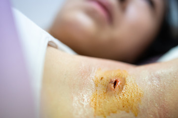 Asian child girl showing surgical wounds,abscess surgery,incision and drainage and clean affected...