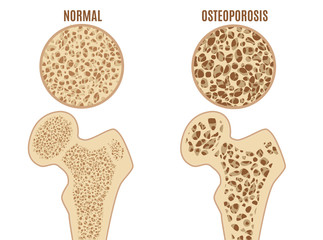 Cartoon Color Osteoporosis Bones Ad Poster Card. Vector - obrazy, fototapety, plakaty