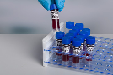 hand in medical gloves put a blood sample in a tube rack