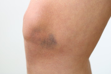 bruises on the woman's knee on white background