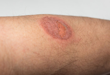 Big burn on the male hand in the healing stage close-up