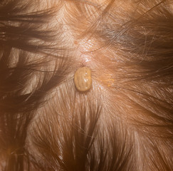 The tick of the blood that was found on the head of a child
