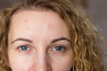 Portrait of young beautiful woman with problematic skin. Post-acne, scars and red festering pimples...