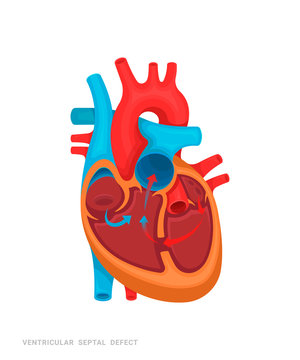 Heart defect. Ventricular septal defect. Illustration for medicine books, websites, apps. Heart disease with name.