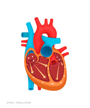 Heart defect. Atrial fibrillation. Illustration for medicine books, websites, apps. Heart disease with name.