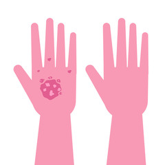 Hands with Psoriasis before and after treatment. Vector illustration