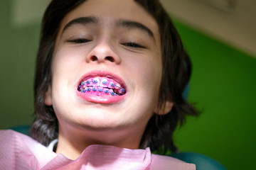 Kid with dental braces and plaque detection on teeth
