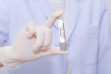 Close up of scientist holding tube for 2019-nCoV analyzing. Novel Chinese Coronavirus blood test Concept.