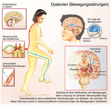 Dystonien.Bewegungsst&ouml;rungen.Basalganglien
