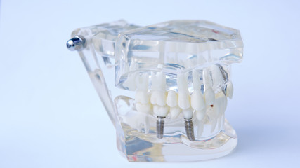 Dentists tooth plastic model with screw implant for teaching, learning and patients in dental office showing teeth and gums.