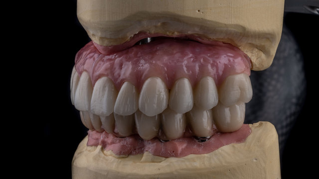 dental implants on a black background