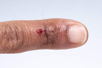 skin wounds and healing problems in a finger: concept of dermocosmetics