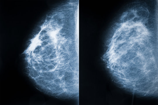 Comparison between breast carcinoma (left) and healthy breast (right). Breast cancer x-ray images or radiographs. Medical and healthcare imagery.
