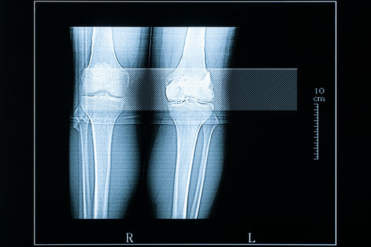 Young Male (25 Years Old) Left And Right Knees CT Scan. Medical And Healthcare Imagery With Scale In Centimeters.