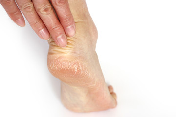 Cracked heel : body parts