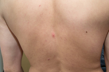 Red pimple on the back of a man right on the spine.