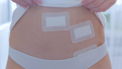 This stock photo features a woman's wounds on her belly after a Laparoscopy surgery.