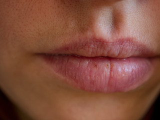 Beautiful female lips cracked from frost, wind, lack of vitamins. Lips need hygienic procedures