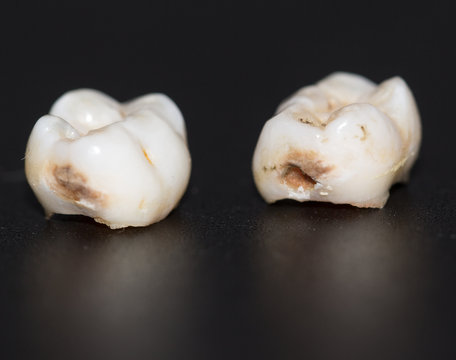 tooth decayed caries on a black background