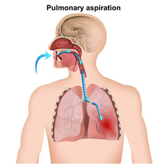 pulmonary aspiration medical infographic  on white background