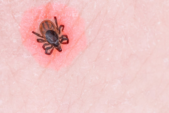 Tick ​​sits on the skin of man. Tick ​​bites a man. Danger of tick bites. Infectious tick. mites bite. Infections and diseases from insects. infection by infection.