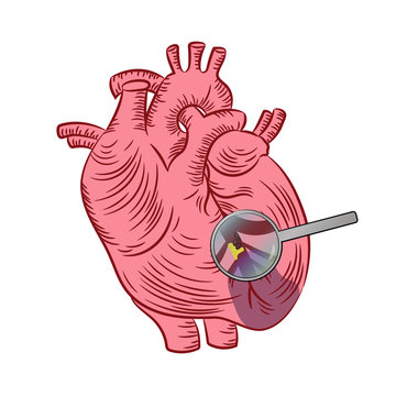 MYOCARDIAL INFARCTION Heart Disease Medicine Education Diagram Vector Scheme Human Hand Draw Vector Illustration