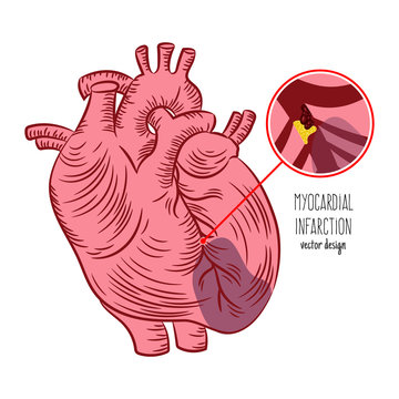 MYOCARDIAL INFARCTION SCHEME Heart Attack Medicine Education Diagram Vector Scheme Human Hand Draw Vector Illustration