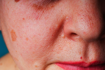 Age spots, moles and freckles on the face close-up. Spots on the skin of the face. Texture of...