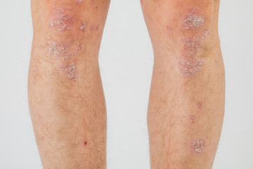 Close-up of the legs of a man suffering from chronic psoriasis on a white background.