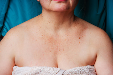 Age spots, moles and freckles on the neck and chest of an older woman. Spots on the body. Decollete...
