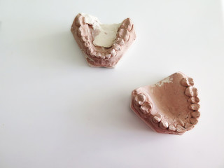 plaster cast denture