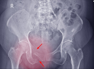 Pelvis and hips joint x-ray