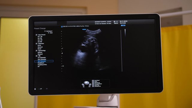 Close-up of black and white image of unborn baby in pregnant woman's womb on ultrasound screen during pregnancy examination in clinic. Screen of ultrasound machine in process of prenatal diagnostics