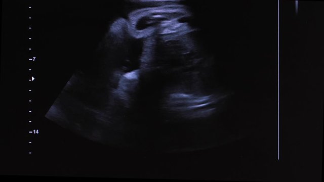 Close-up of ultrasound screen showing image of fetus in pregnant woman's womb during prenatal diagnostics in hospital. Moving ultrasound picture of unborn child in third trimester of pregnancy