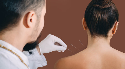 Asian acupuncturist doing acupuncture back to relieve woman's shoulder pain. Traditional Chinese medicine. Acupuncture needles close-up - obrazy, fototapety, plakaty