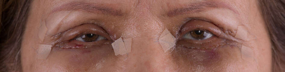 Eyes of an old woman after plastic surgery,blepharoplasty,eye bag removal