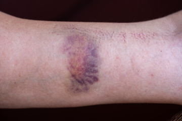 Purple bruise on the skin on a woman hand