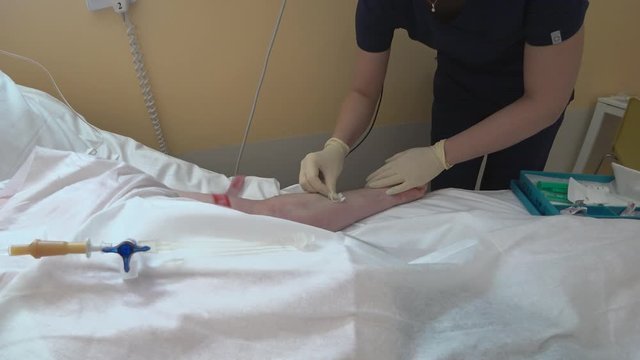 An indesating nurse carefully wipes the patient's hand with a disinfectant tampon. Before installing a venous catheter, the nurse carefully disinfects the installation site on the patient's arm.