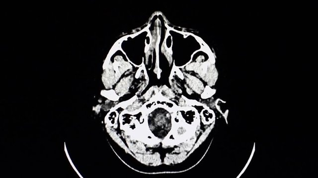 A monitor showing a computer tomographic slices of a human's brain.